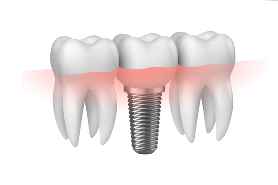implantologia bergamo